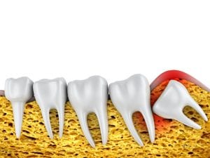 check in with your dentist about wisdom teeth removal