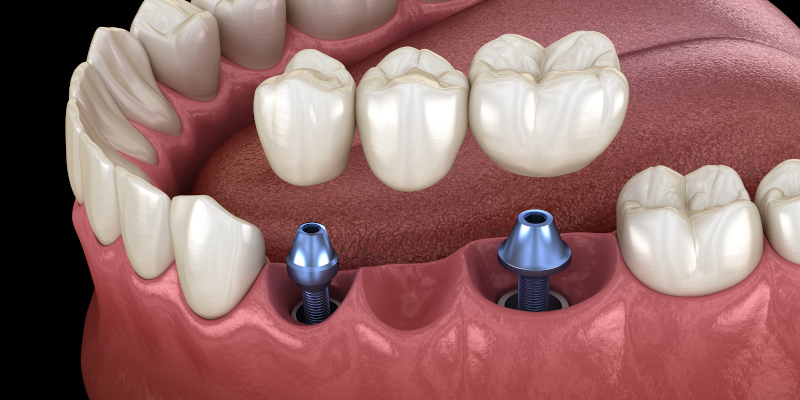 Implant-Retained Dentures in Walkertown, North Carolina
