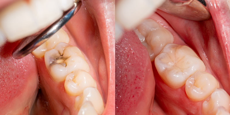 Important Advice for Caring for your Composite Restorations